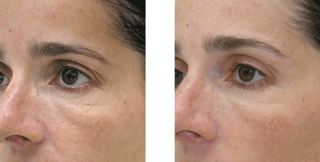 ΜΕΣΟΘΕΡΑΠΕΙΑ