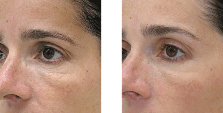 ΜΕΣΟΘΕΡΑΠΕΙΑ