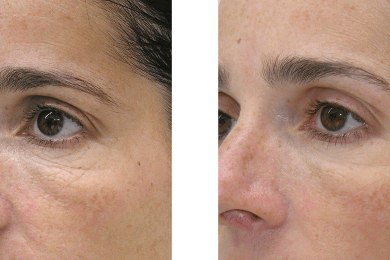 ΜΕΣΟΘΕΡΑΠΕΙΑ