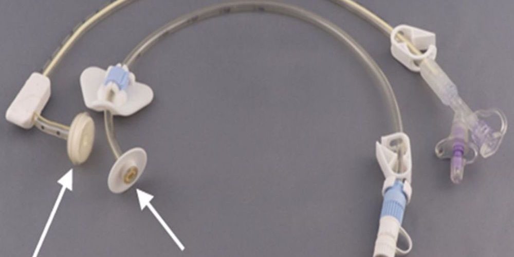 ΣΩΛΗΝΕΣ ΓΑΣΤΡΟΣΤΟΜΙΑΣ