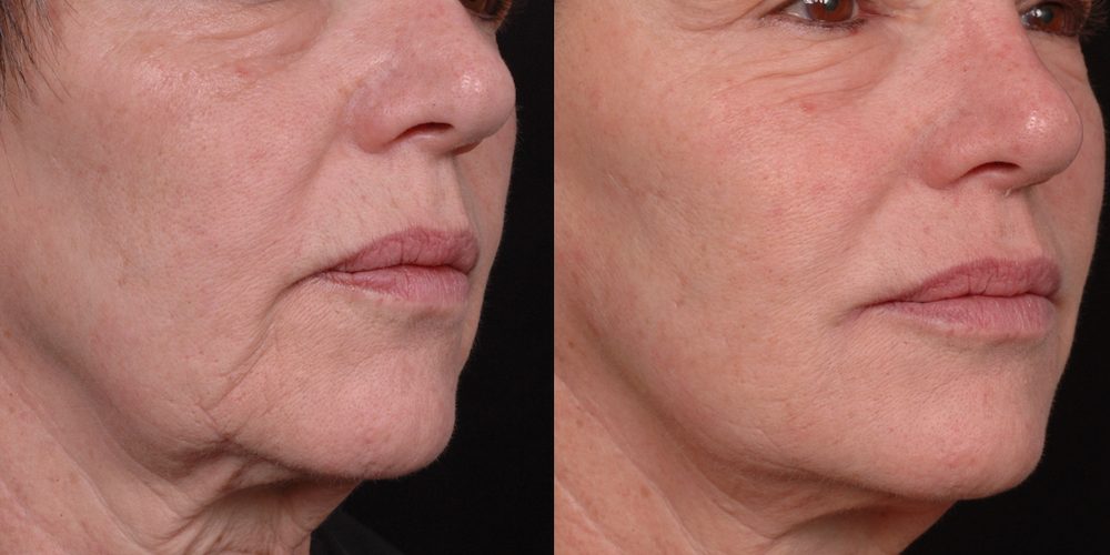 ΓΕΜΙΣΜΑ ΡΥΤΙΔΩΝ ΜΕ ΥΑΛΟΥΡΟΝΙΚΟ