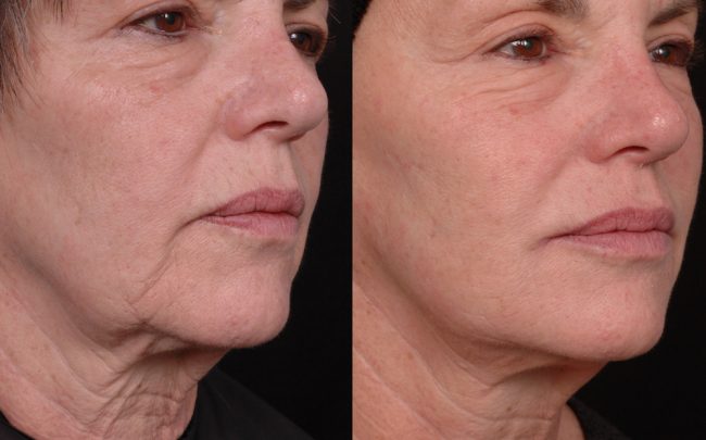 ΓΕΜΙΣΜΑ ΡΥΤΙΔΩΝ ΜΕ ΥΑΛΟΥΡΟΝΙΚΟ