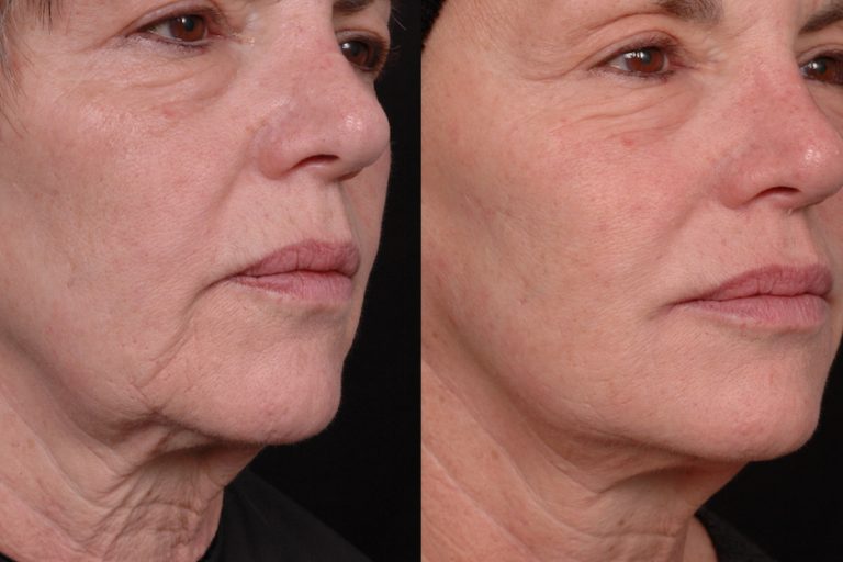 ΓΕΜΙΣΜΑ ΡΥΤΙΔΩΝ ΜΕ ΥΑΛΟΥΡΟΝΙΚΟ