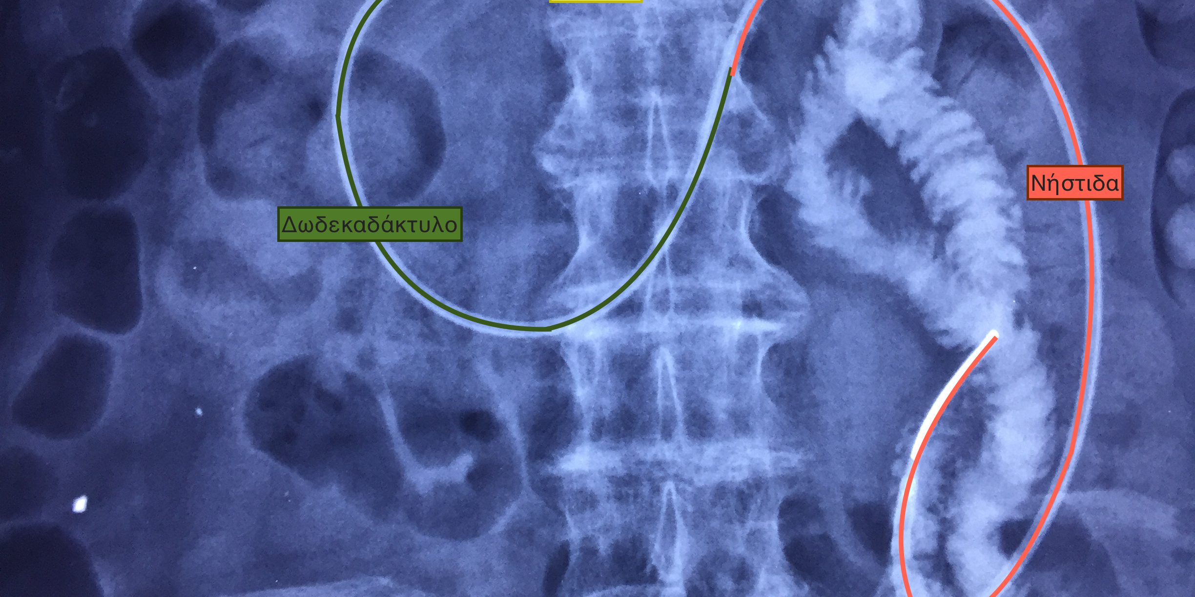 Γαστρονηστιδοστομια