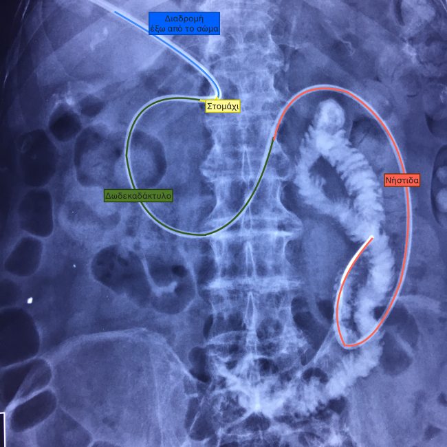 Γαστρονηστιδοστομια Γαστρονηστιδοστομια