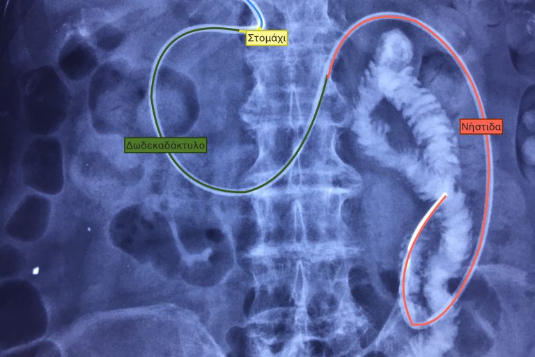 Γαστρονηστιδοστομια