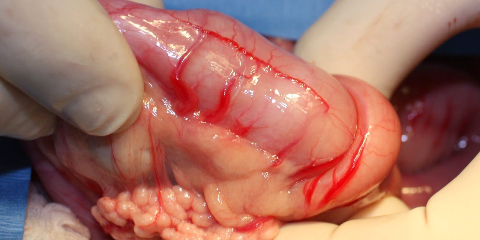 αναστομωση εντερου