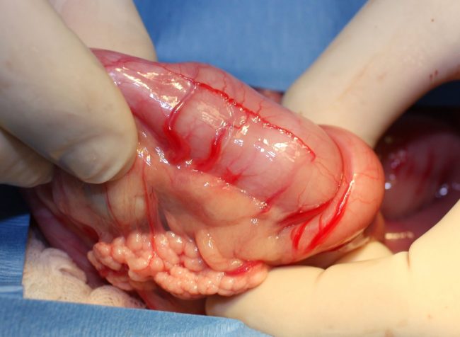 αναστομωση εντερου αναστομωση εντερου