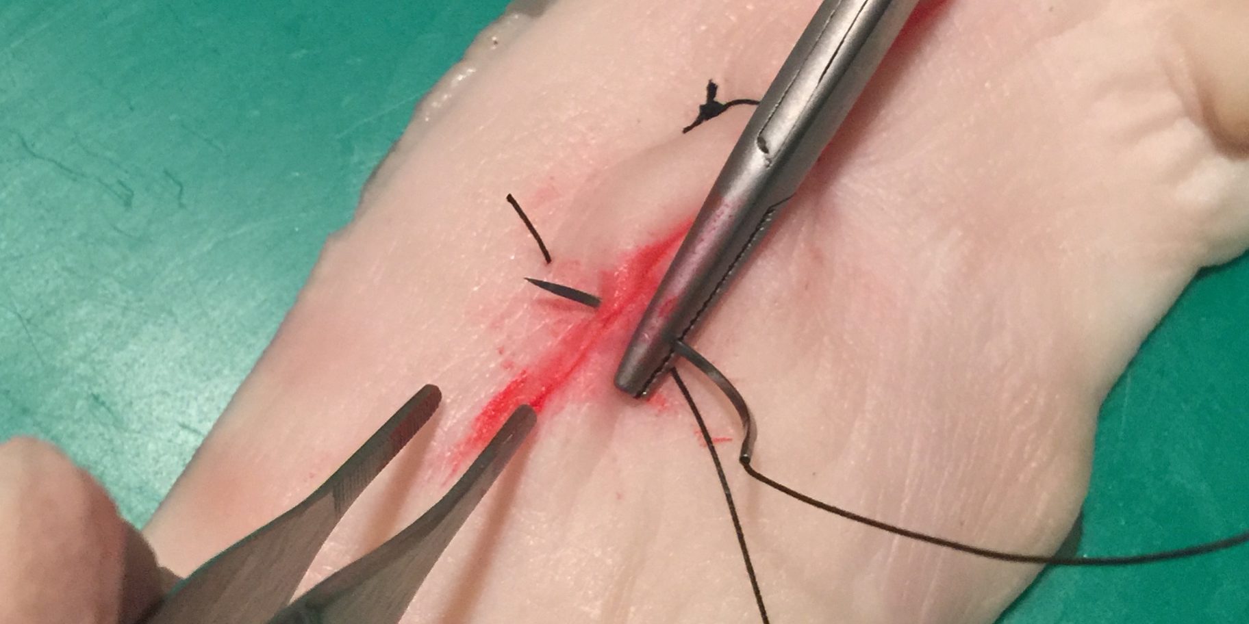 Συρραφη τραυματος Συρραφη τραυματος