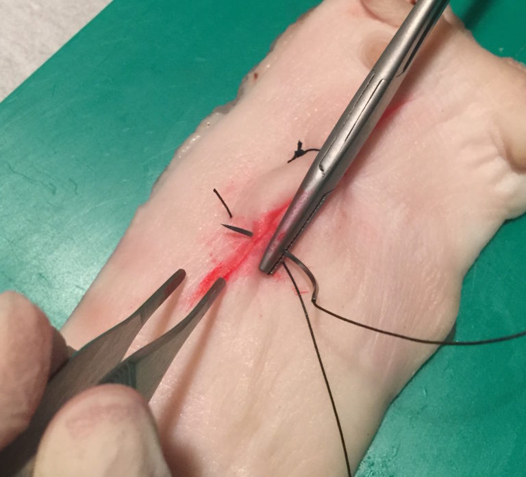 Συρραφη τραυματος