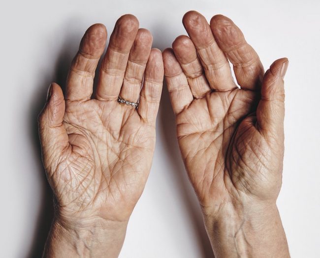 Απίσχνανση