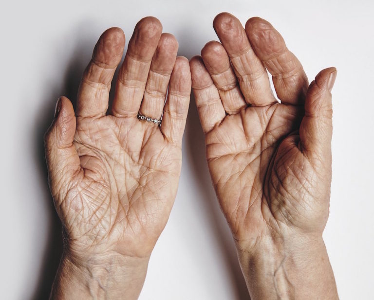 Απίσχνανση